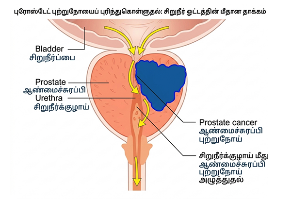 இஸ்ரேல் பிரதமரின் அறிவிப்புக்கு பின் உலக கவனம் – புரோஸ்டேட் புற்றுநோய் குறித்து அவசர விழிப்புணர்வு